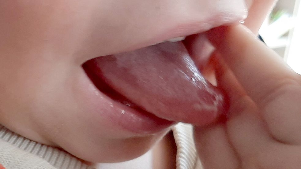 Diese Zunge wurde im Klinikum Oldenburg genäht. Der einjährige Lias kann die Zunge inzwischen auch wieder rausstrecken. Foto: Privat