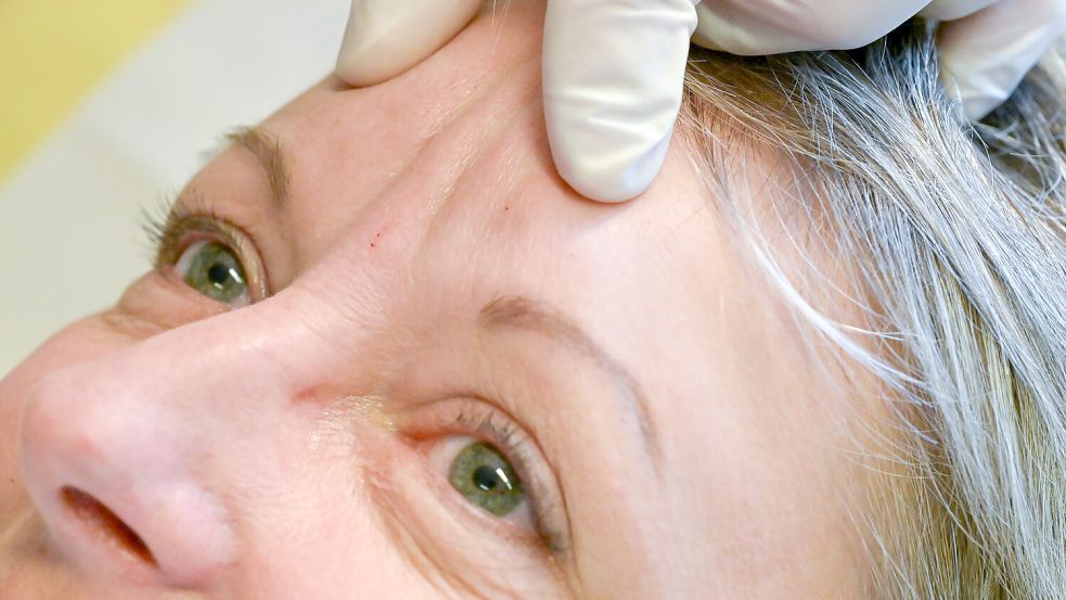Die sogenannten senkrechten Zornesfalten zwischen und über den Augenbrauen lassen sich mit Botox behandeln. Foto: Klaus Ortgies